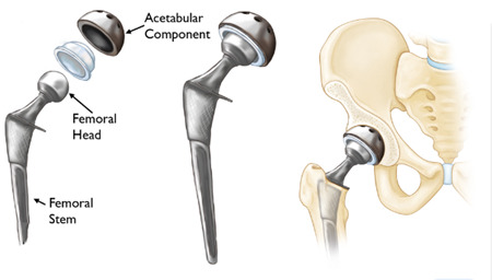 Inner Bore of Medical Ceramic Hip