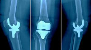 hip or knee joint grinding02.png